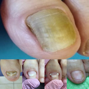 Оніхогрифоз