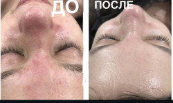 Механічна чистка обличчя Врач-косметолог Альона Одесса