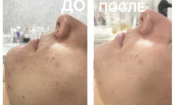 Атравматическая 3D чистка Лікар-косметолог Альона Одеса