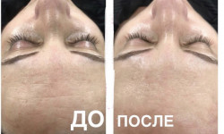 Поверхностные пилинги  (всесезонные) Лікар-косметолог Альона Одеса
