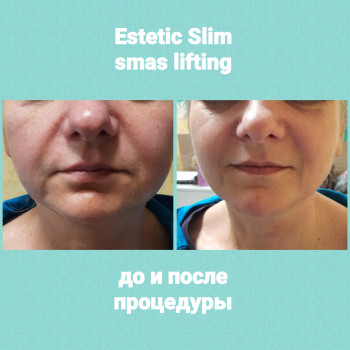 Коррекция нижней трети
Smas lifting Ulthera