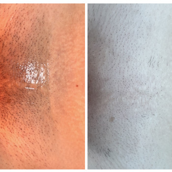 Элос епіляція
                    Косметолог-инъекционист Виктория Полтава