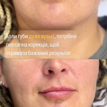 Збільшення губ
                    Косметолог-инъекционист Виктория Полтава