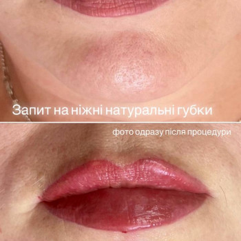 Збільшення губ
                    Косметолог-инъекционист Виктория Полтава