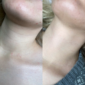 Бланшинг
                    Косметолог Виктория Киев