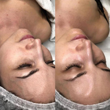 Пінний ферментативний догляд (Foaming Enzyme Treatment Facial )від IS Clinical
                    Врач-косметолог Марина Черкассы