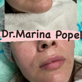 Корекція обʼєму та форми губ
                    Врач-косметолог Марина Черкассы