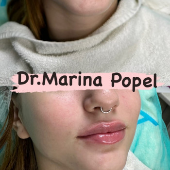 Корекція обʼєму та форми губ
                    Врач-косметолог Марина Черкассы