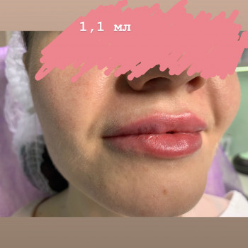 Корекція обʼєму та форми губ
                    Врач-косметолог Марина Черкассы