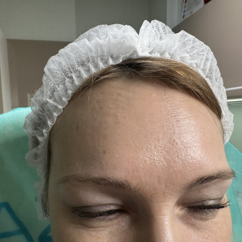 Корекція мімічних зморшок ботулотоксином (ботулінотерапия) або ботокс- Ксеомин, Ботокс
                    Преподаватель курсов красоты Марина Черкассы