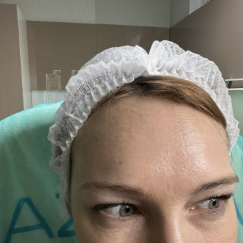 Корекція мімічних зморшок ботулотоксином (ботулінотерапия) або ботокс- Ксеомин, Ботокс
                    Преподаватель курсов красоты Марина Черкассы