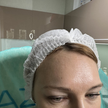 Корекція мімічних зморшок ботулотоксином (ботулінотерапия) або ботокс- Ксеомин, Ботокс
                    Преподаватель курсов красоты Марина Черкассы