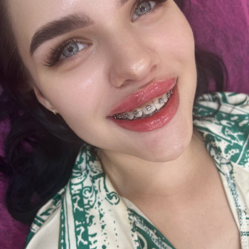 Увеличениегуб #