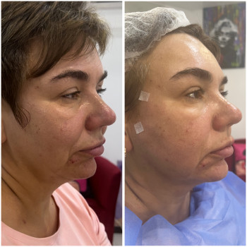 Постановка ниток # Cog # по 3 шт на сторону 
Результатов одразу після процедури