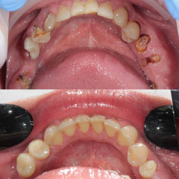 робота реставрація зубів