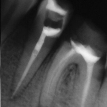 лікування каналів та реставрація зубів