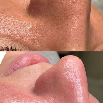 Чистка обличчя
                    Лікар-косметолог Ирина Краматорськ