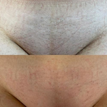 Lumenis Desire Лазерна епіляція ноги повністю (жіночі)
                    Косметологический центр Ендосфера центр Кременчуг