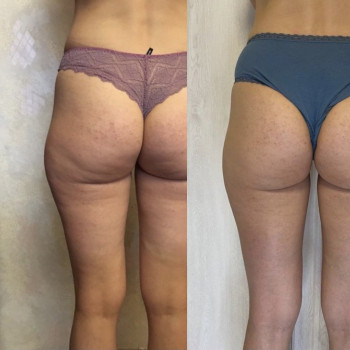 Фото из портфолио мастера Филипп Черногал (массажист, Днепр)