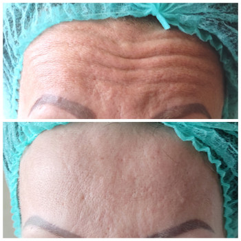 Ботокс лоб, міжбрів'я, очі. Ефект 4-6 місяців без зморшок
   