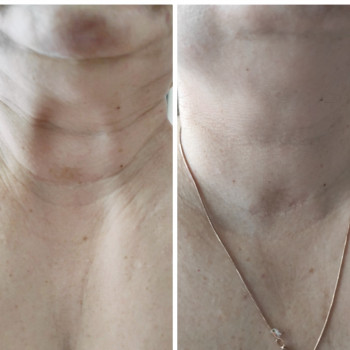 Колагеностимуляція та мезоботокс для шиї
   