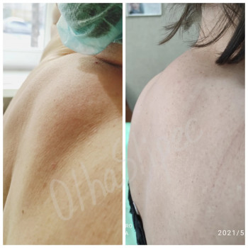 Ліполітики для усунення жирових відкладень.
   борщагівка 