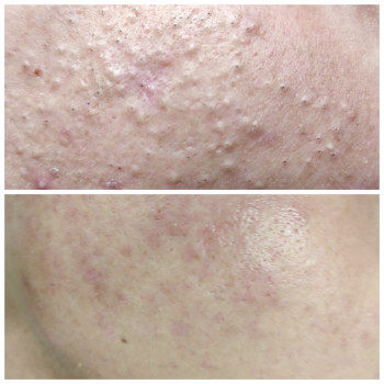 Комбінована лікувальна чистка обличчя. Якісна професійна косметика Gigi, renew, phd
  