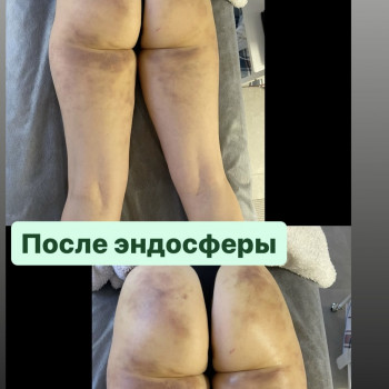 Аппаратный массаж
                    Массажист Вика Одесса