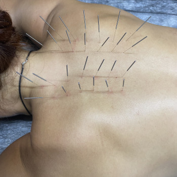 Голкорефлексотерапія
                    Массажист  Одесса