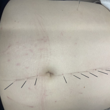 Голкорефлексотерапія
                    Массажист  Одесса