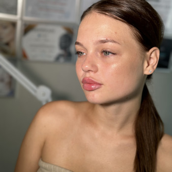 Збільшення губ
                    Косметолог-инъекционист Любов Бердичев