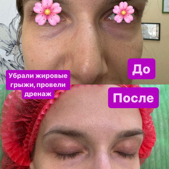  #лікування жирових гриж