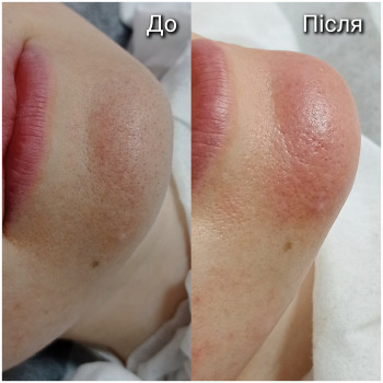 Комбінована чистка
 
 