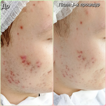 Лікувальна процедура для шкіри з акне
 
 
 