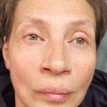 Наше До процедуры