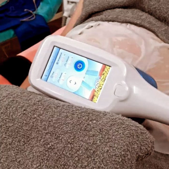 Кріоліполіз живіт