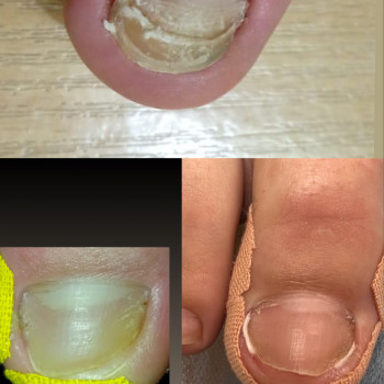 Травми нігтя