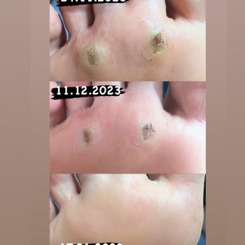 Бородавки До/Після