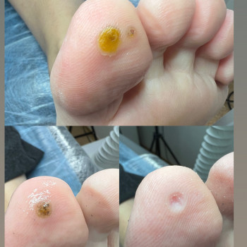 Бородавки До/Після