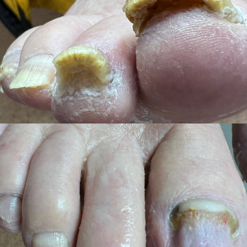 Грибкова інфекция