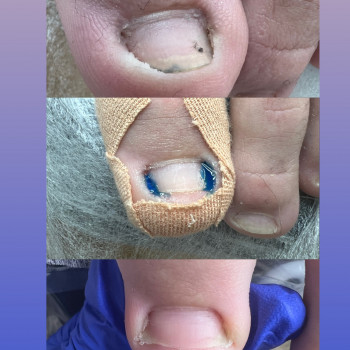 Врісший ніготь