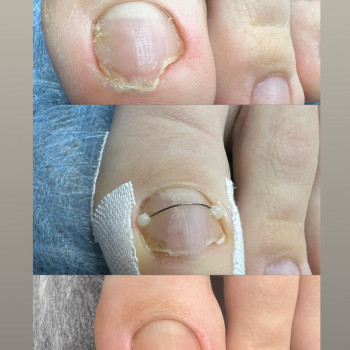 Титанова нитка