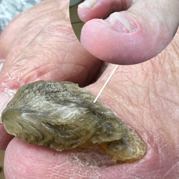 Онихогрифоз