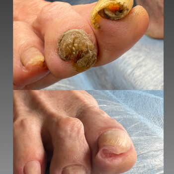 Грибкова інфекция