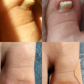 Деформований ніготь