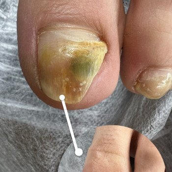 травмовані нігті