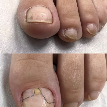 тітанова нитка