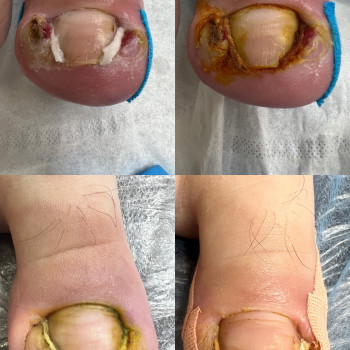 Врісший ніготь