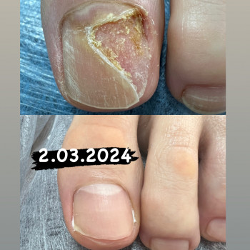 Травмовані нігті

 
 
 