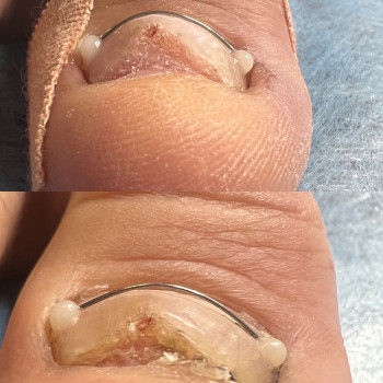 Титанова нитка

 
 
 